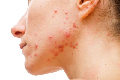 Treat the Embarrassing Effects of Acne the Natural Way