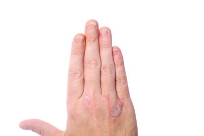 Alleviate the Symptoms of Psoriasis With Soothing Oils and Extracts